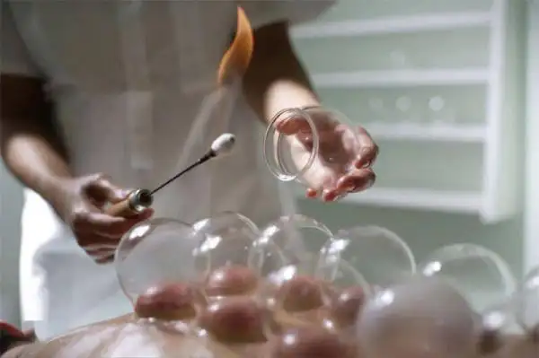 Chinese cupping massage benefits